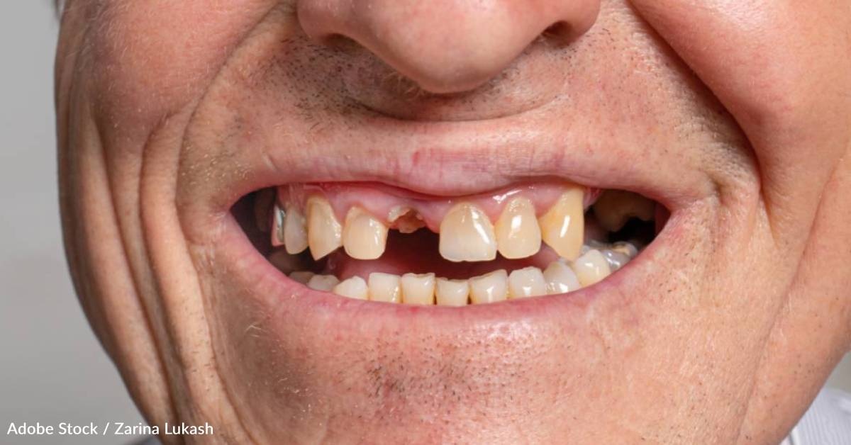 Diabetes and Tooth Loss Impact Brain